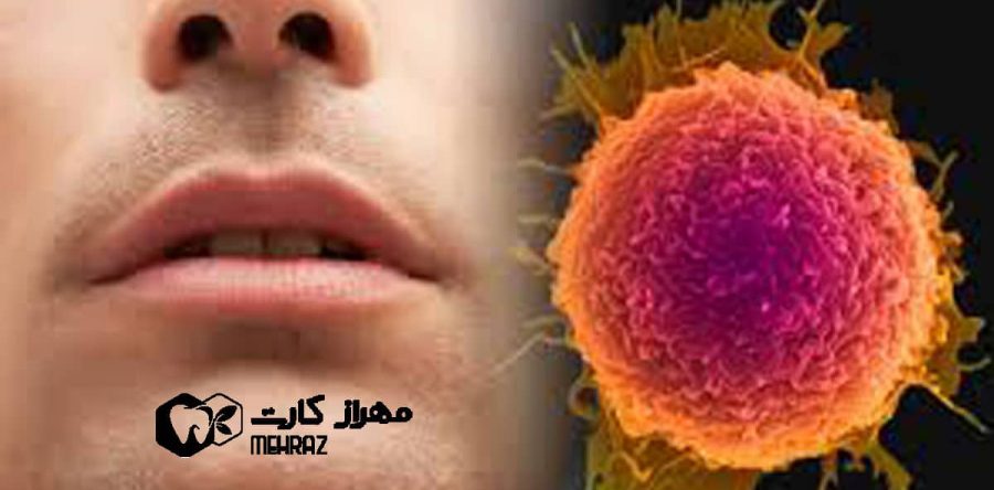 عوارض شیمی درمانی بر دهان و دندان