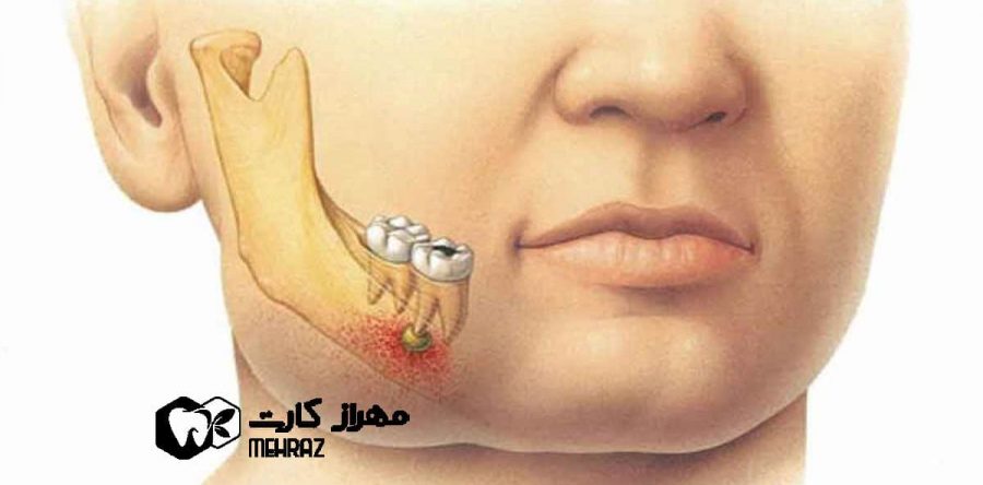 پیله دندان | پیشگیری