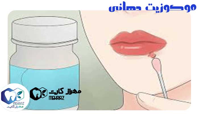 موکوزیت دهانی ✅ درمان موکوزیت چیست؟