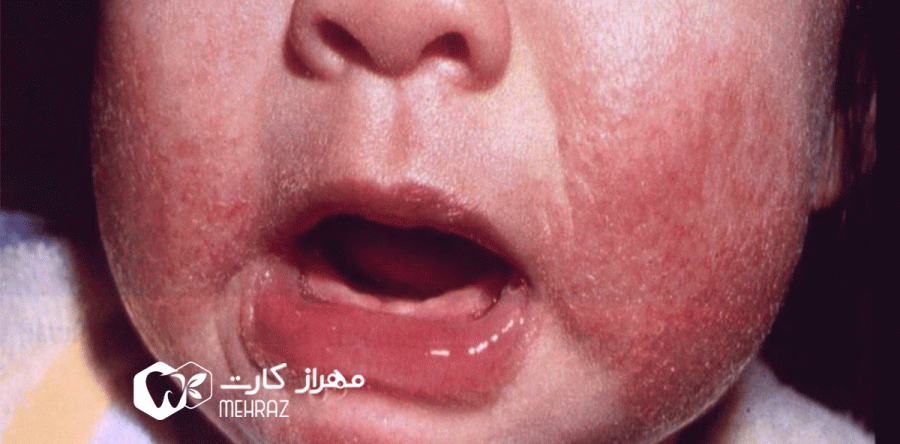 پوسته ریزی اطراف دهان | علل