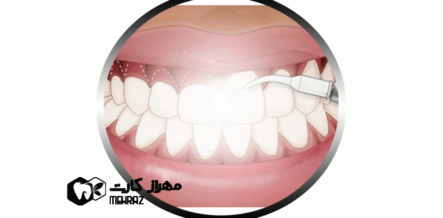 لثه برداری (جینجیوکتومی) چیست؟