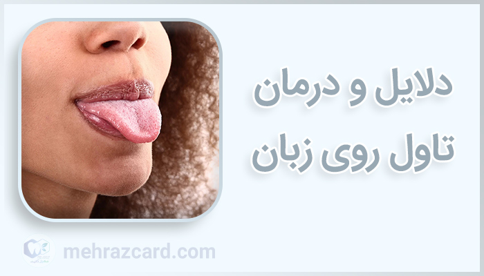 تاول روی زبان | درمان تاول روی زبان