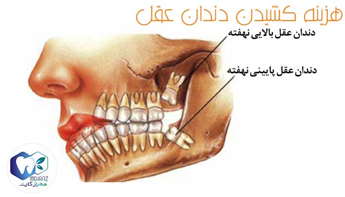 قیمت کشیدن دندان عقل ✅ هزینه کشیدن دندان