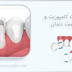 تفاوت کامپوزیت و لامینت دندان کامپوزیت