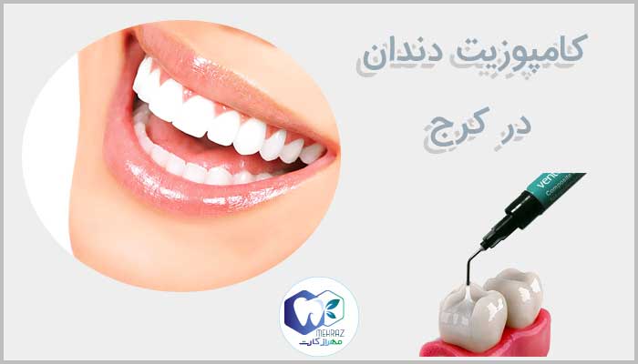 کامپوزیت دندان در کرج