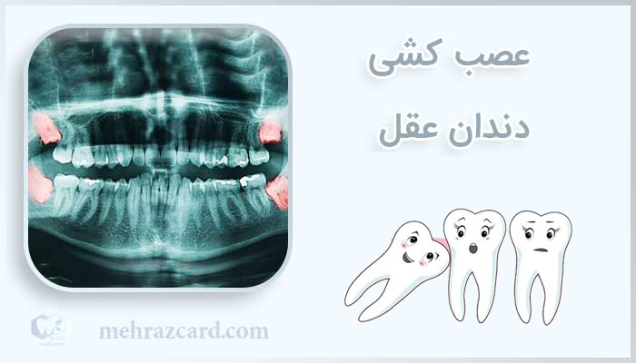 عصب کشی دندان عقل