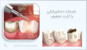 خدمات دندانپزشکی با کارت تخفیف