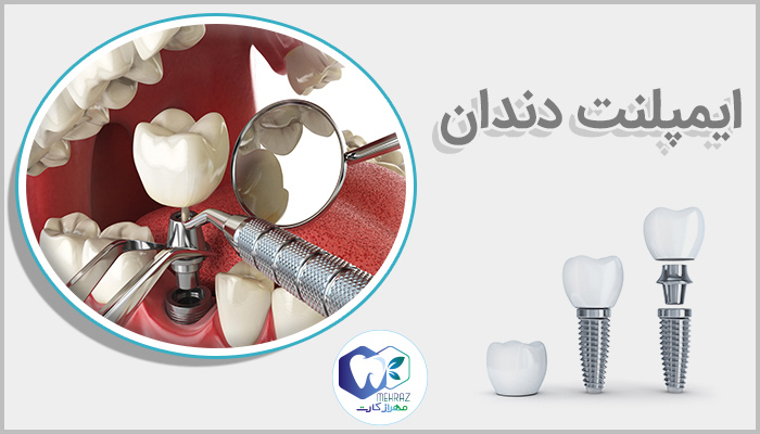 بیمه ایمپلنت دندان