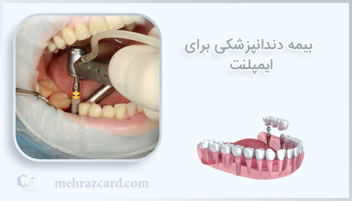 بیمه دندانپزشکی برای ایمپلنت