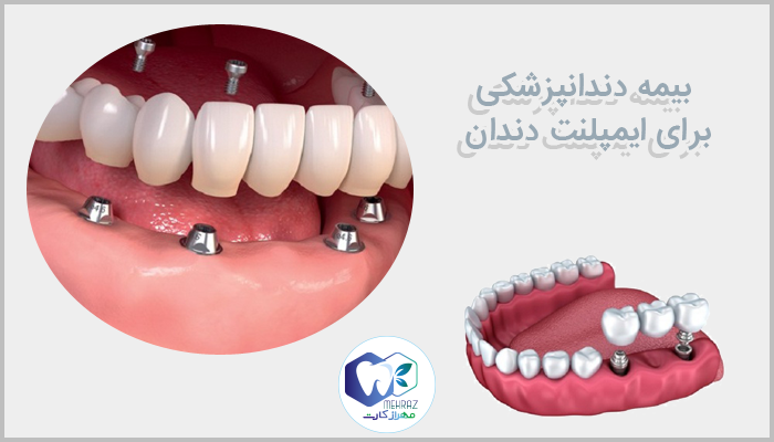 بیمه دندانپزشکی برای ایمپلنت دندان