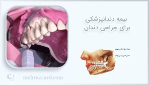 بیمه دندانپزشکی برای جراحی دندان