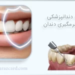 بیمه دندانپزشکی برای جرم گیری دندان