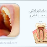 بیمه دندانپزشکی برای عصب کشی