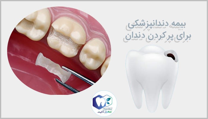 بیمه دندانپزشکی برای پرکردن دندان