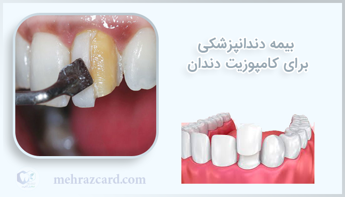 بیمه دندانپزشکی برای کامپوزیت دندان