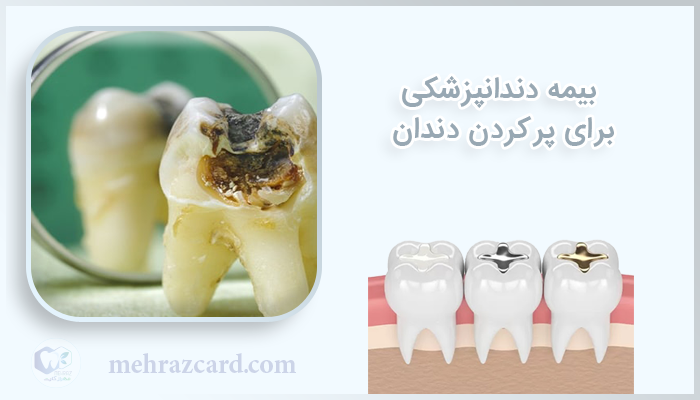بیمه دندانپزشکی برای پر کردن دندان