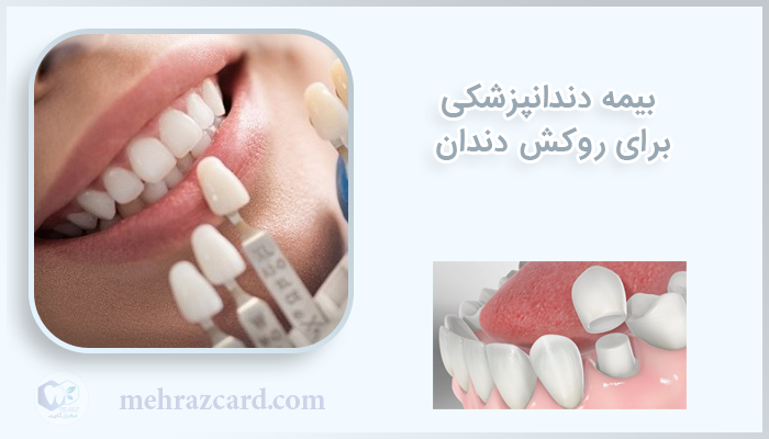 بیمه دندانپزشکی برای روکش دندان