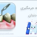 هزینه جرمگیری دندان | قیمت جرمگیری