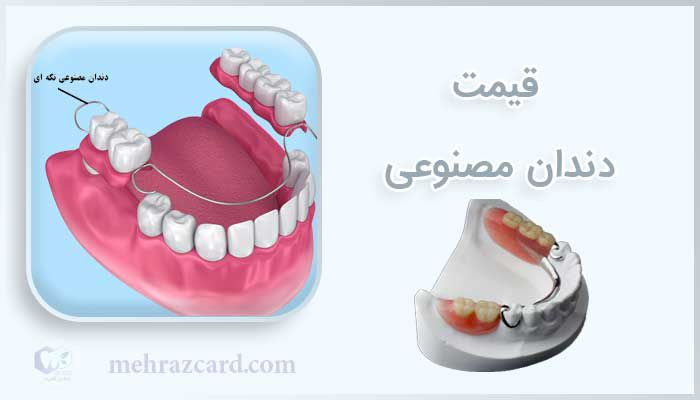هزینه دندان مصنوعی | قیمت دندان مصنوعی