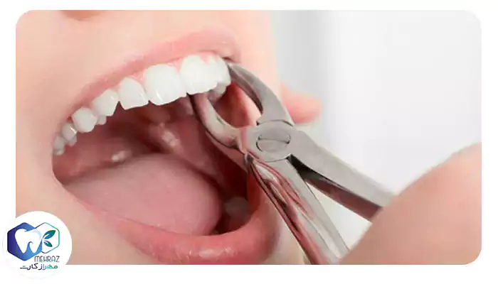 کشیدن دندان