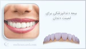 بیمه دندانپزشکی برای لمینت دندان