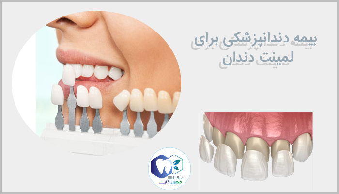 بیمه دندانپزشکی برای لمینت دندان