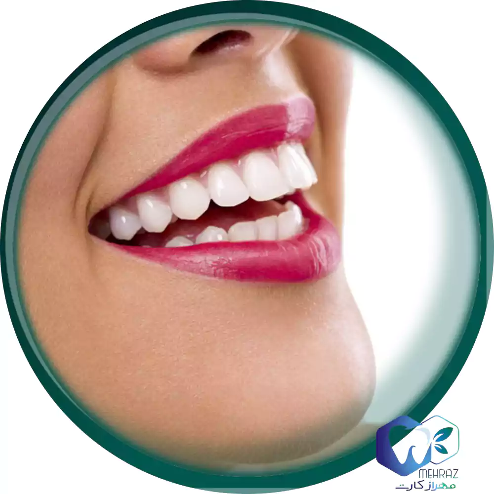 بلیچینگ دندان با آخرین قیمت خدمات دندانپزشکی