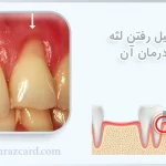 تحلیل رفتن لثه