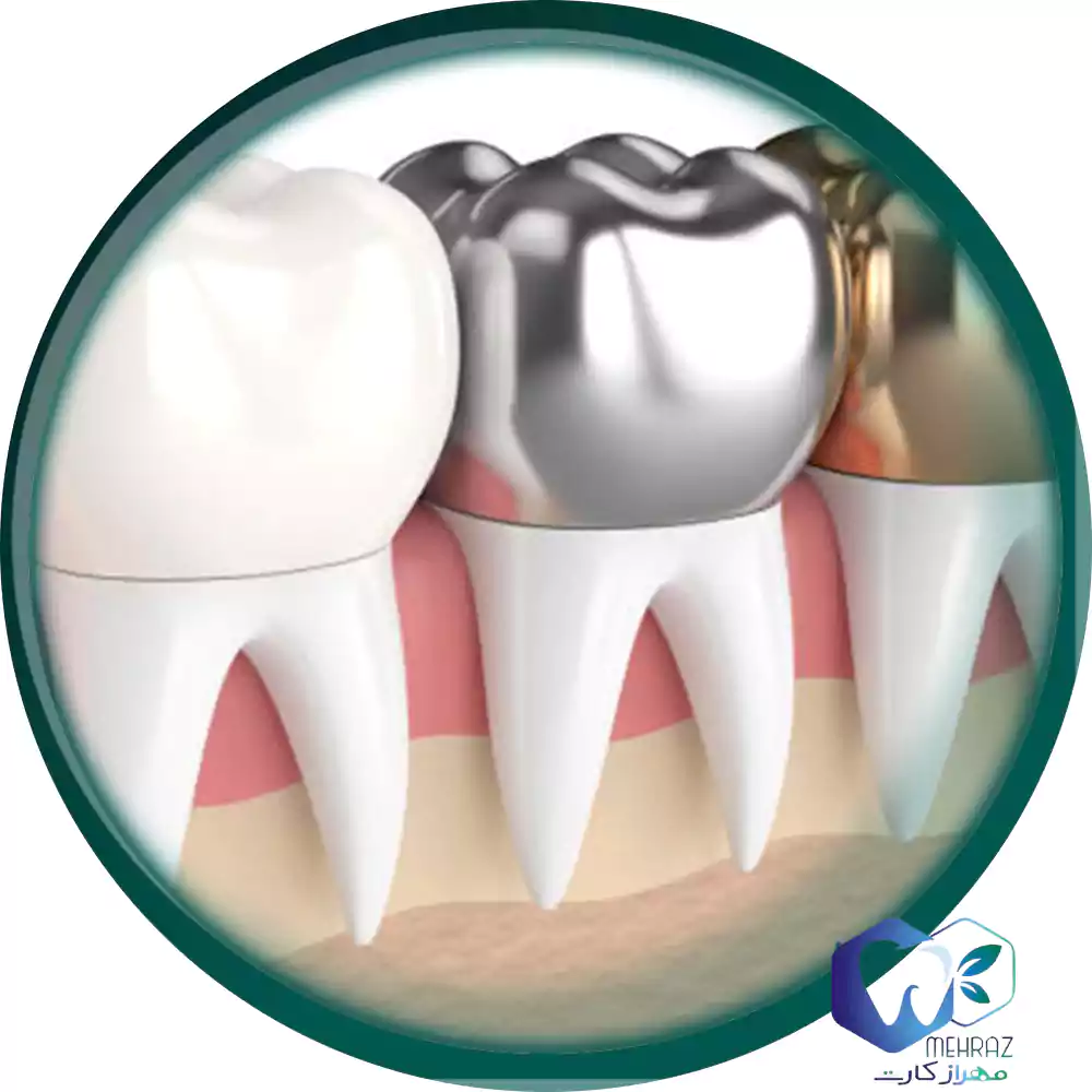 روکش دندان با آخرین قیمت خدمات دندانپزشکی
