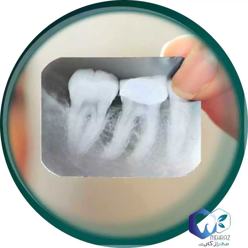عصب کشی دندان با آخرین قیمت خدمات دندانپزشکی