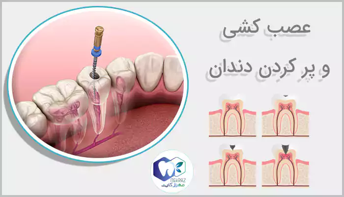 عصب-کشی-و-پر-کردن-دندان-1