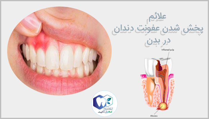 علائم پخش شدن عفونت دندان در بدن