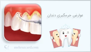 عوارض جرمگیری دندان