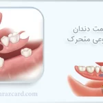 قیمت دندان مصنوعی متحرک