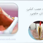 قیمت عصب کشی دندان جلویی