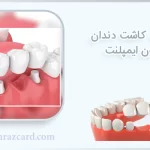 قیمت کاشت دندان بدون ایمپلنت