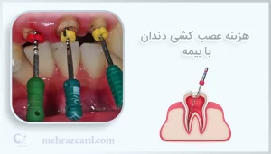 هزینه عصب کشی دندان با بیمه