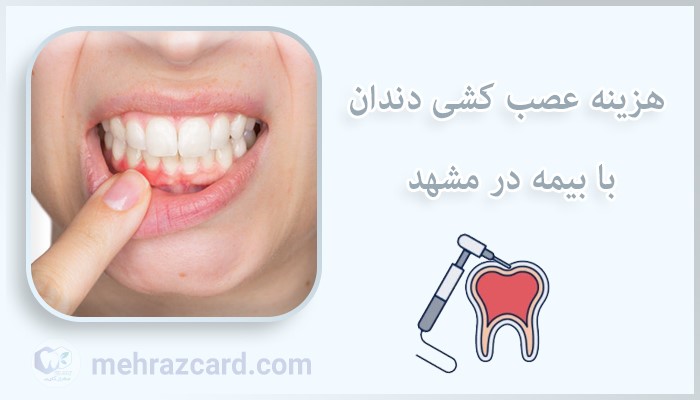 هزینه عصب کشی دندان با بیمه در مشهد