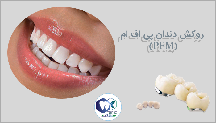 روکش دندان پی اف ام (PFM)