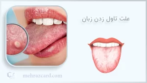 علت تاول زدن زبان