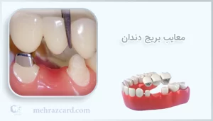 معایب بریج دندان