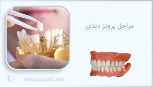 مراحل پروتز دندان