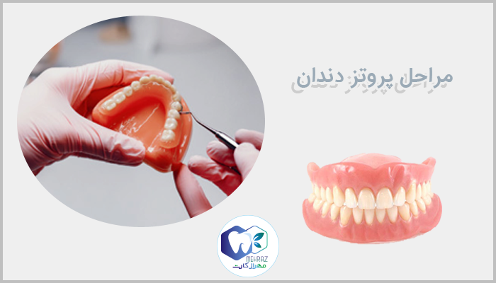 مراحل پروتز دندان