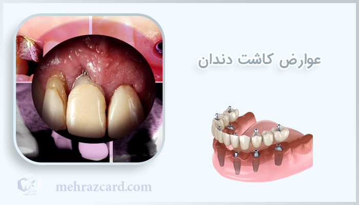 عوارض کاشت دندان