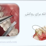 جراحی لثه برای روکش