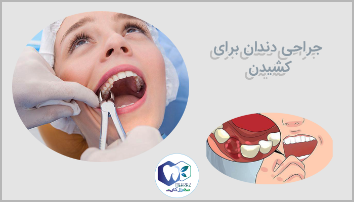 جراحی دندان برای کشیدن