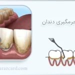 معایب جرمگیری دندان