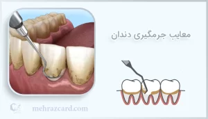 معایب جرمگیری دندان