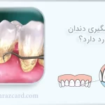 جرمگیری دندان درد دارد ؟