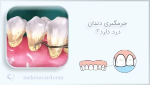 جرمگیری دندان درد دارد ؟
